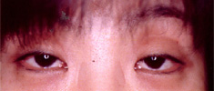 両側眼瞼下垂症1