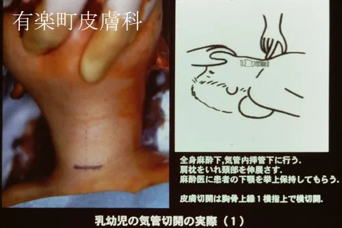 気管切開術1