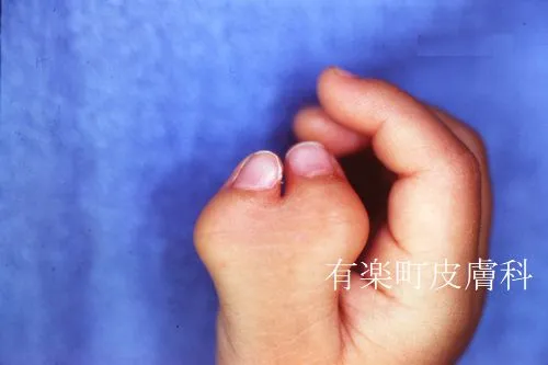 手指手足1