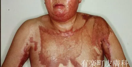 全身火傷2