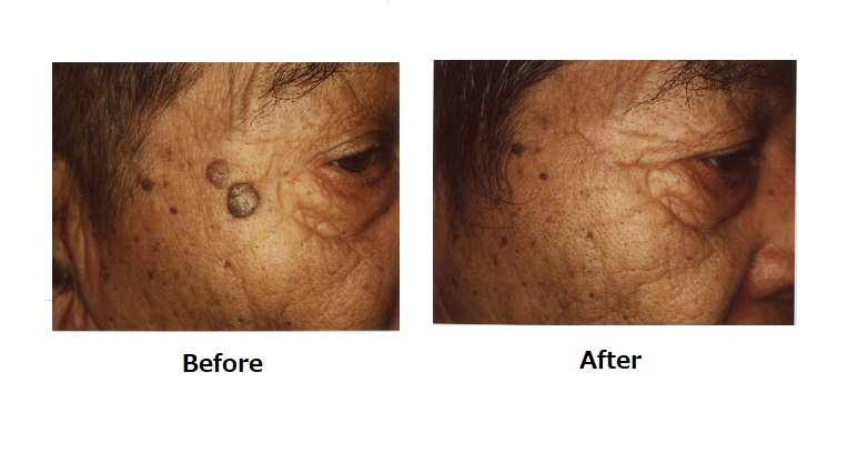 ケラトアカントーマ患者の今後の見通しはどうなりますか?