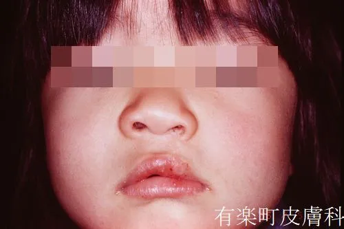口唇裂術4