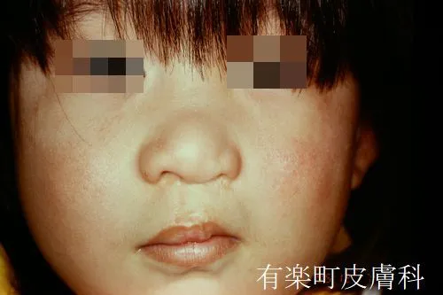 口唇裂術2