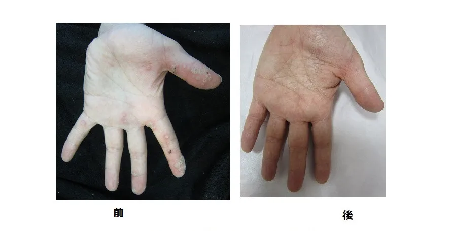 外用PDT3