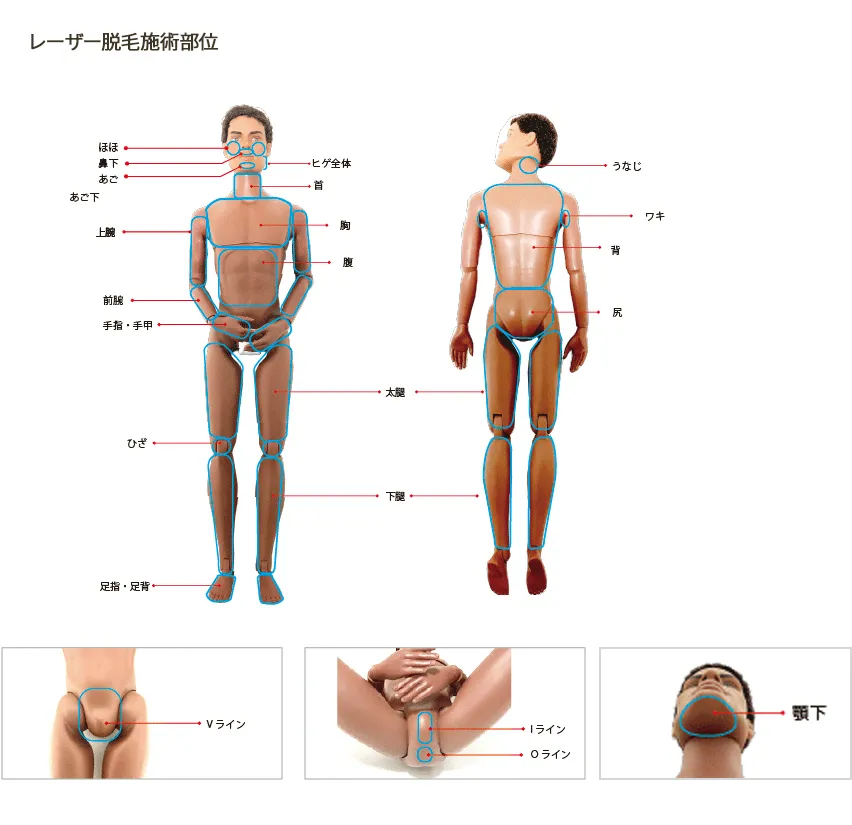 レーザー脱毛施術部位