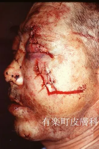 外傷9