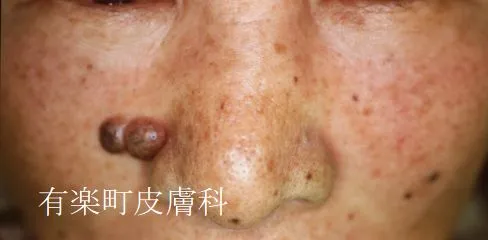 ホクロ症例写真1-2前