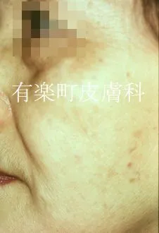ホクロ症例写真3-1後