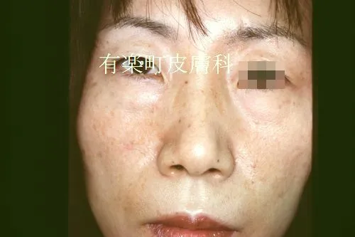 ホクロ症例写真5-1後