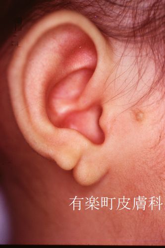 副耳および耳垂裂1