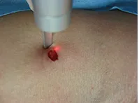 治療