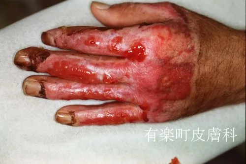 熱傷1