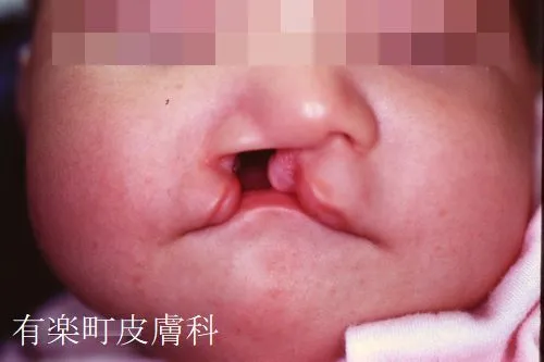 口唇裂術5