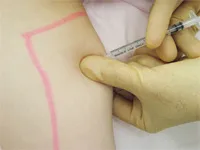 脂肪溶解注射