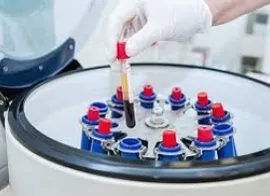 STEP3:治療開始日は 採血から2週間以降の予定です。 PRP製剤が届き次第、早期治療ご希望の方はお申し付けください。