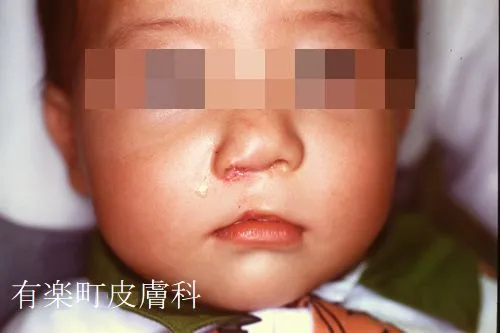 口唇裂術6