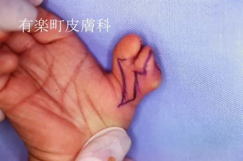 手指手足3