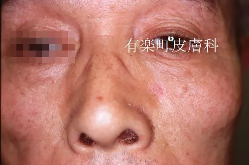 ホクロ症例写真6-2後