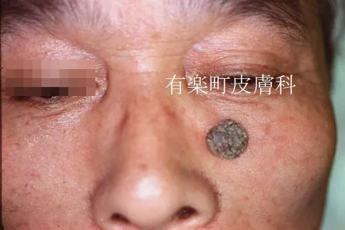 ホクロ症例写真6-2前