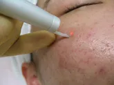 炭酸ガスレーザー照射