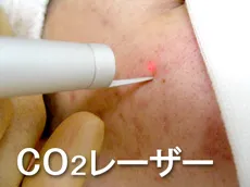 CO2 炭酸ガスレーザー治療