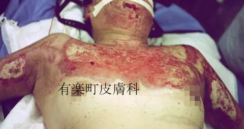 全身火傷1