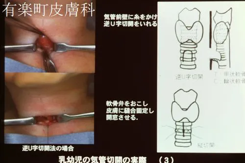 気管切開術2