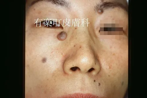 ホクロ症例写真5-1前