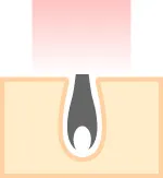 剃毛後、レーザーの光を当てます。