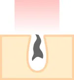 光が毛根のメラニンに反応し、熱に変わります。