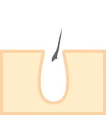 毛根が破壊され、