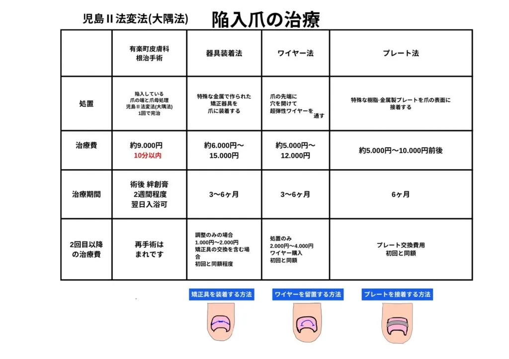 陥入爪(巻き爪)の治療