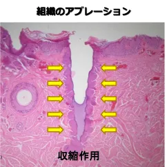 エコツーフラクショナルレーザーについて