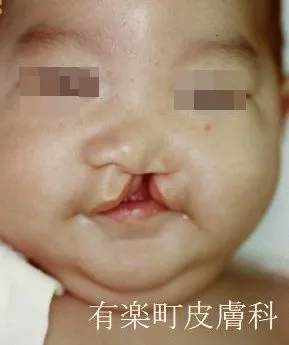 口唇裂術1