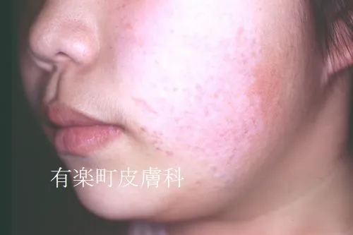 保険適応レーザー治療症例15