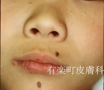 ホクロ症例写真9-1前