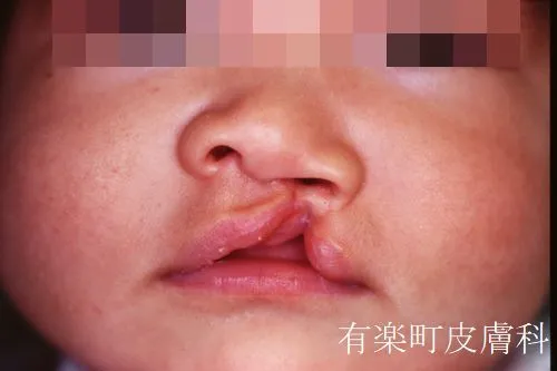 口唇裂術3