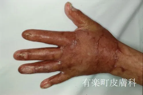熱傷2