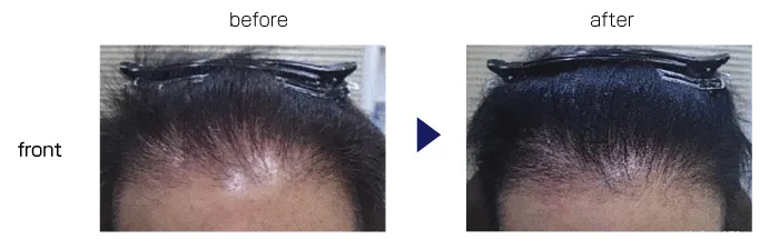 4回施術前