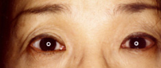 両側眼瞼下垂症4