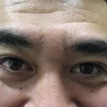 眉間before
