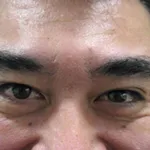 眉間after