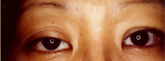 右眼瞼下垂症3