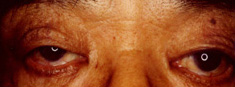 右眼瞼下垂症5