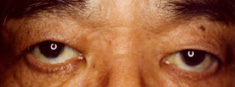右眼瞼下垂症6