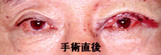 右眼瞼下垂症8