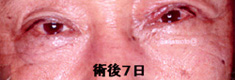 右眼瞼下垂症9