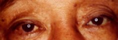 右眼瞼下垂症10