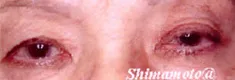 右眼瞼下垂症11