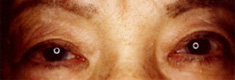 右眼瞼下垂症12